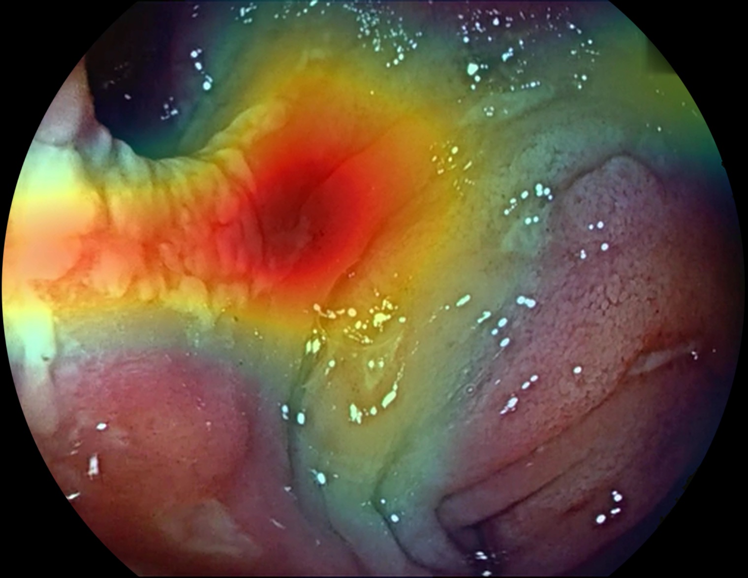 Colonoscopy frame with the Mucosal Intelligence severity heatmap highlighting the ulcerated area in red
